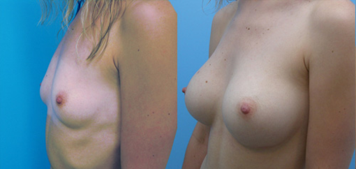 Naturalism in Breast Augmentation Surgery