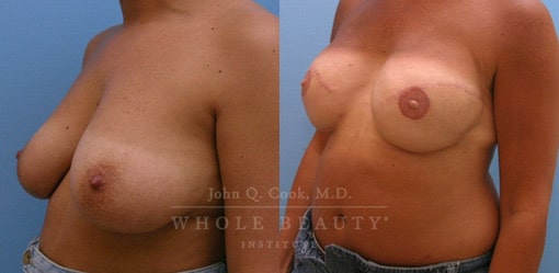 breast-reduction-case-01