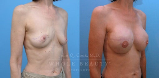 breast-reduction-case-05