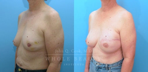breast-reduction-case-04
