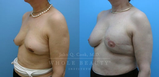 breast-reduction-case-07