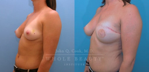 breast-reduction-case-09