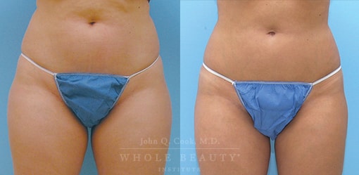 Vaser Ultrasonic Liposuction, Performed on the Thighs, Knees & Lower Abdomen