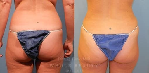 liposuction-case-5-03