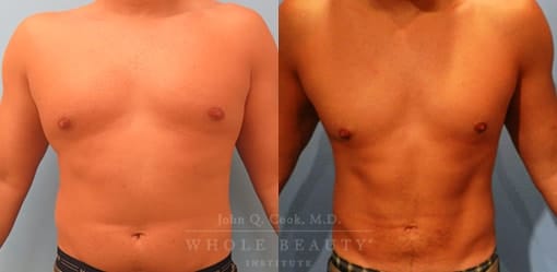 Liposuction Under Local Anesthesia - before and after