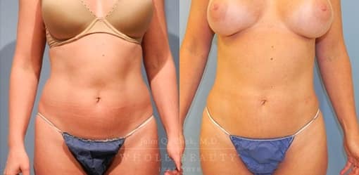 liposuction-case-5-01