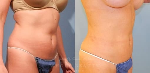 liposuction-case-5-03