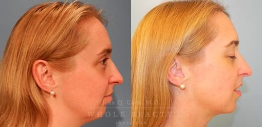 liposuction-case-5-01