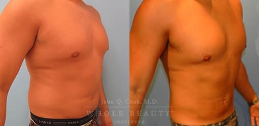 liposuction-case-5-03