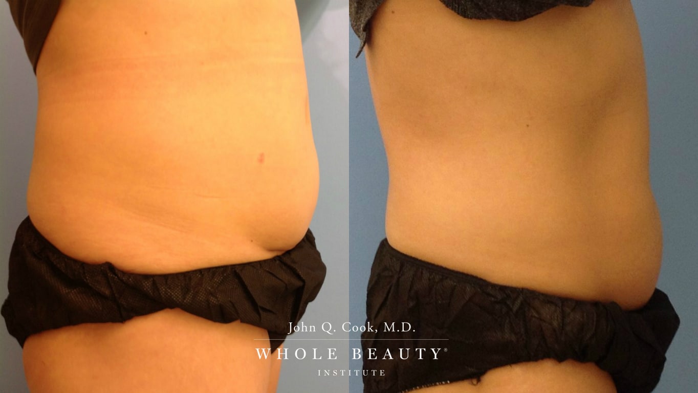 Sculpsure Before and After | Whole Beauty® Institute