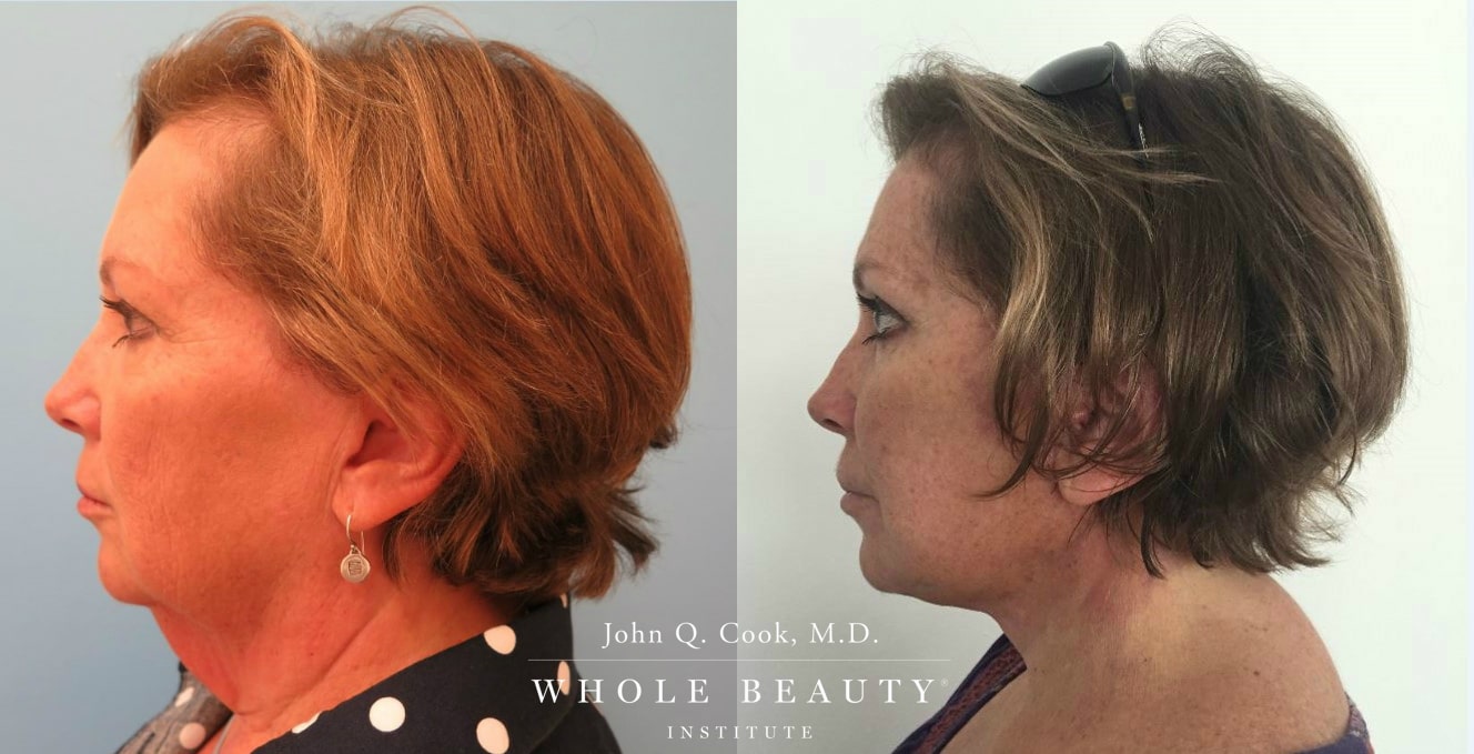 Facelift Under Local Anesthesia performed by Dr. John Q. Cook