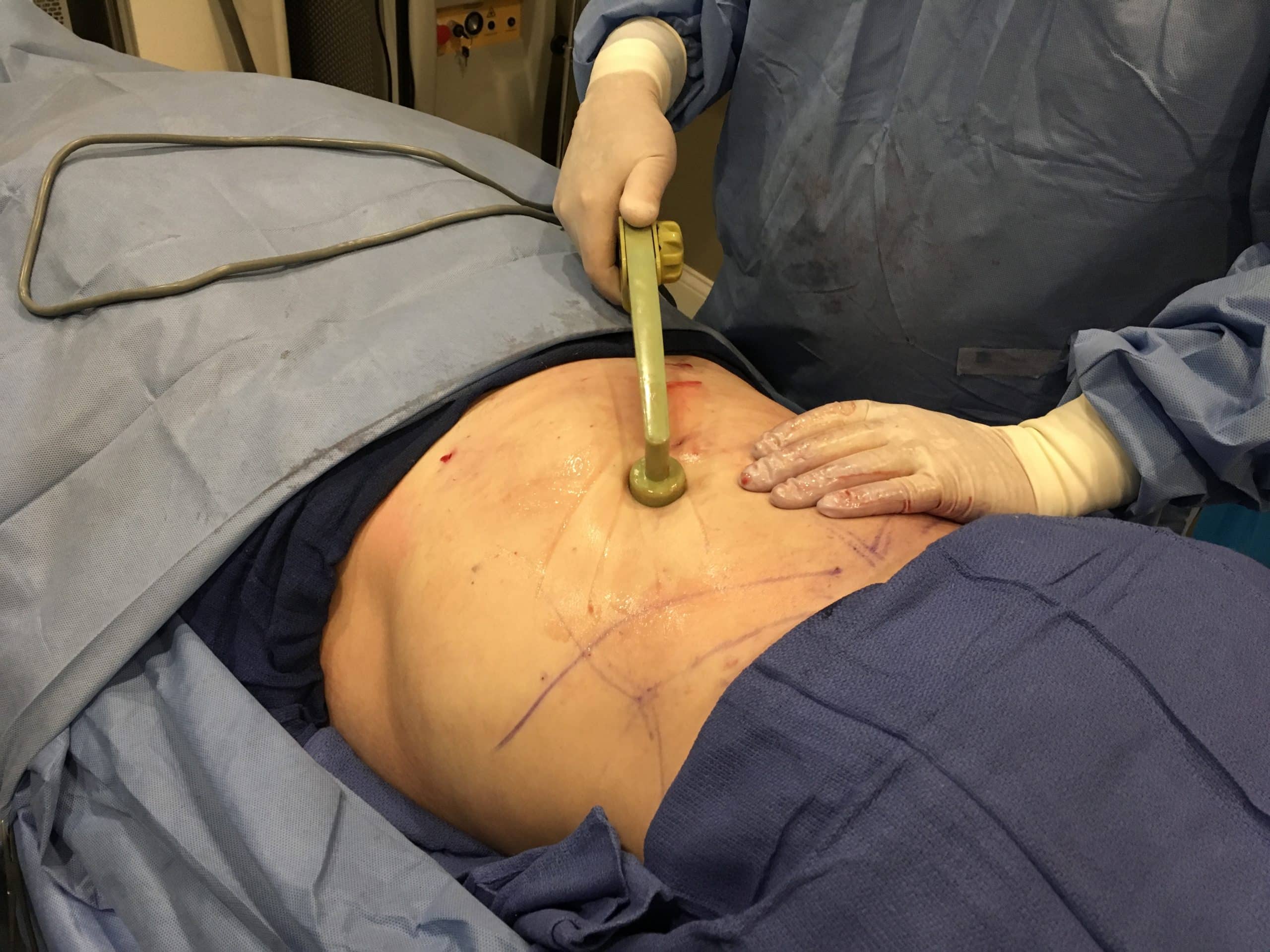 Dr. Cook performs BodyTite® on a patient.