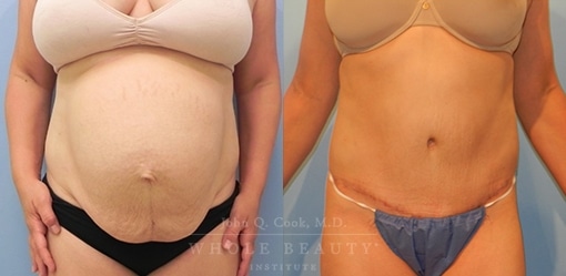 abdominoplasty-case-16