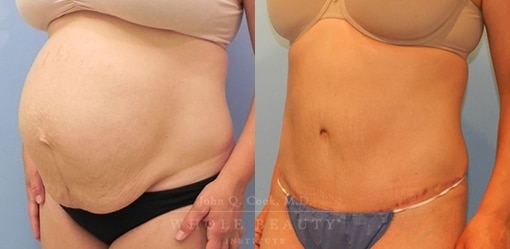 abdominoplasty-case-06-side