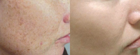 A series of IPL treatments before and after