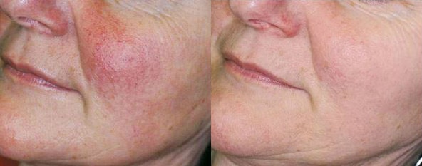 IPL reduction of Rosacea