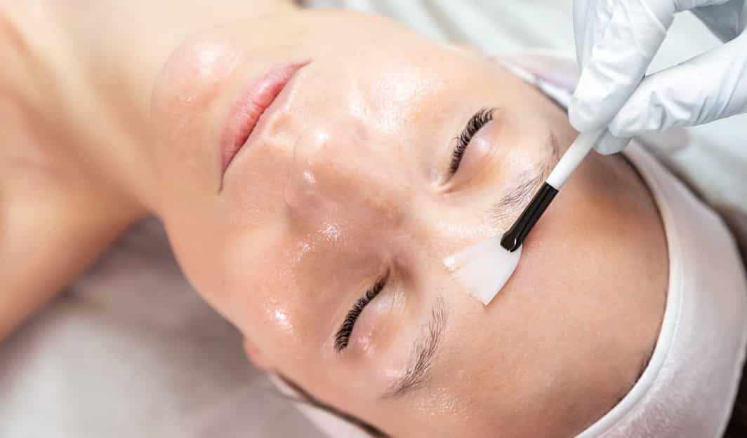 facial peel