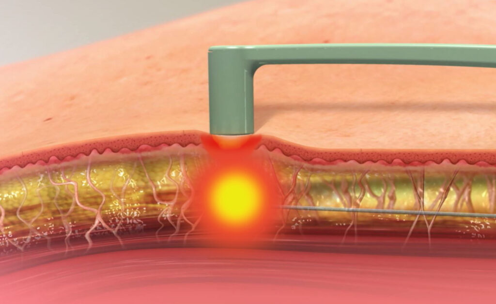 facetite procedure