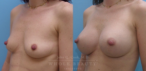 Breast Augmentation Before and After