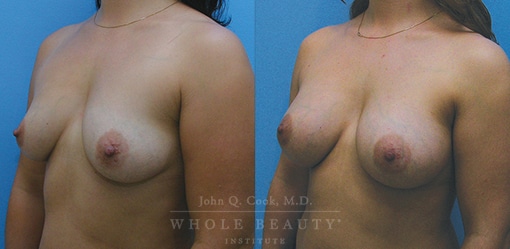 breast aug before and after