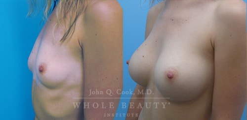 breast implants before and after