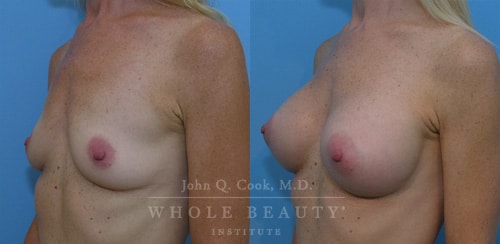 Breast Augmentation Before and After