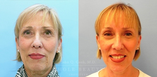 facelift before and after