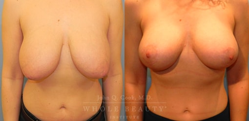 front facing structural breast surgery