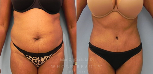 abdominoplasty-case-19