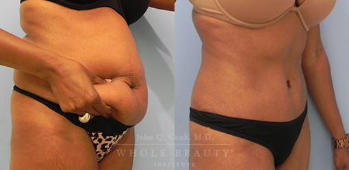 abdominoplasty-case-06-side
