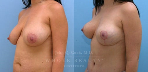 structural breast surgery patient