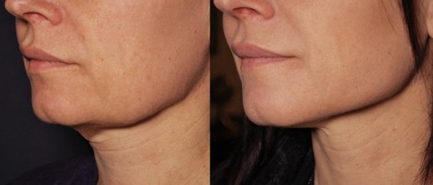 EmbraceRF Before and After Photo EmbraceRF Before and After Photo