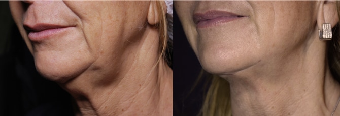 EmbraceRF Before and After Photos EmbraceRF Before and After Photos