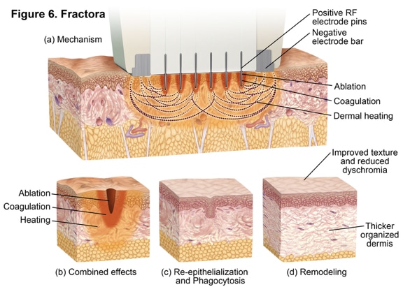 Fractora Illustration