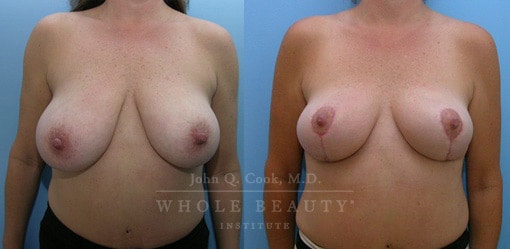 Structural Breast Reduction before and after