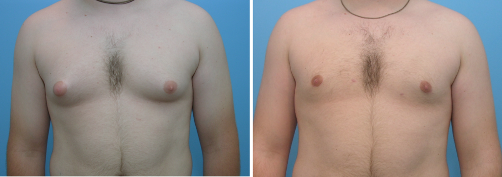 Breast Reduction for Men | Before and After
