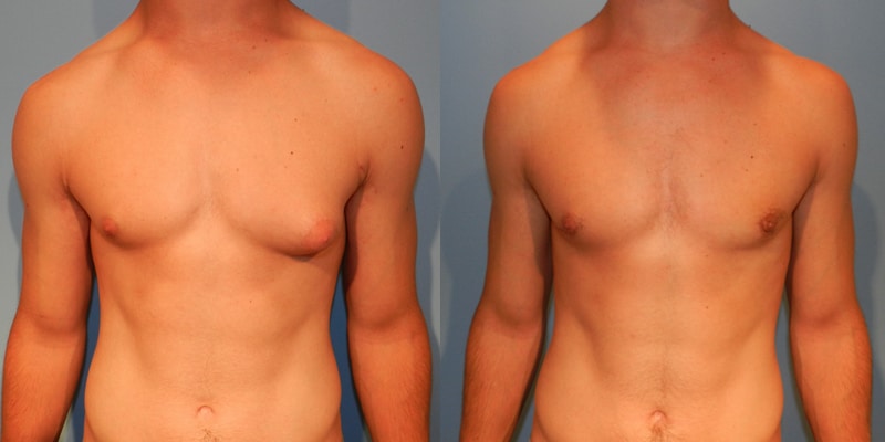 before and after - gynecomastia