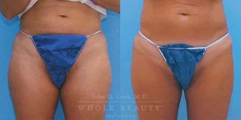 lipo-2 lipo