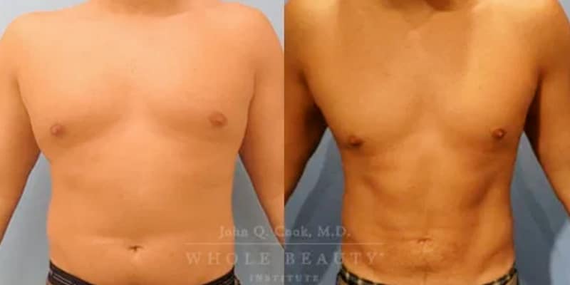 lipo-3 lipo