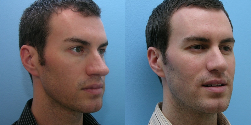 before and after - rhinoplasty