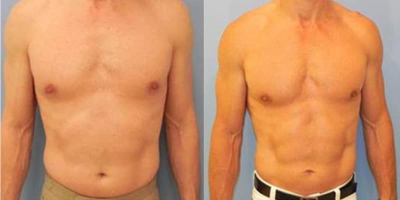before and after - slimlipo before and after - slimlipo