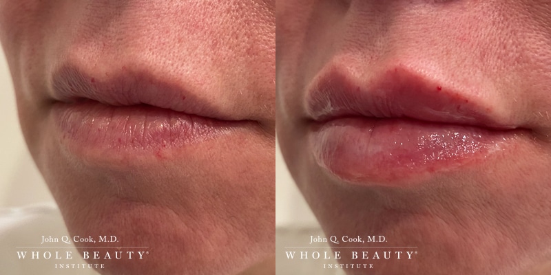 lip filler before and after