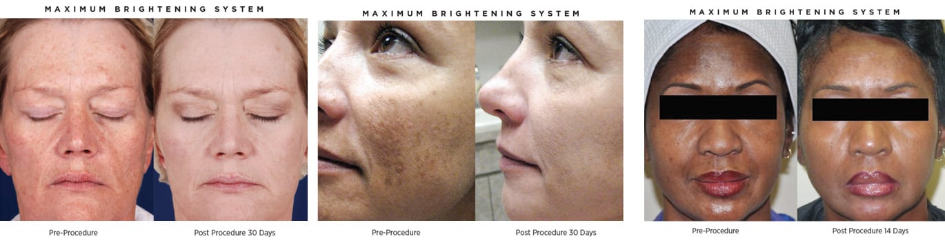 maximum brightening peels