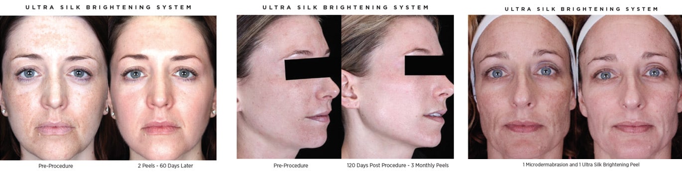 ultra brightening peels