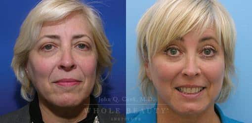 Facelift before and after