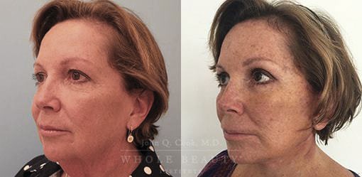 Facelift before and after