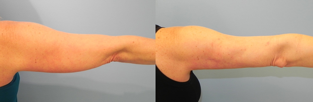 arm before and after