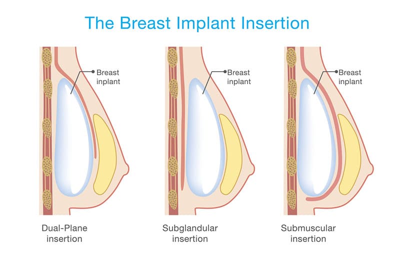 Breast implant placement