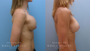 Breast Revision Surgery