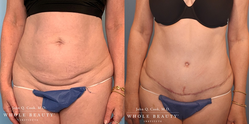 tummy tuck before and after
